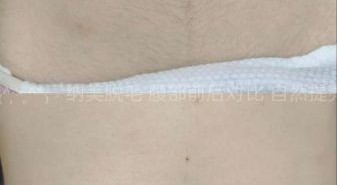 孕妇肚子上长毛正常吗_怎么去除