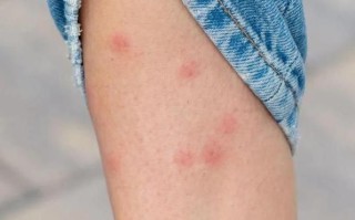 孕妇梦见很多蚊子_孕妇梦见蚊子是什么意思