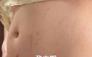 孕妇胆汁淤积是哪里痒_胆汁淤积瘙痒部位图解