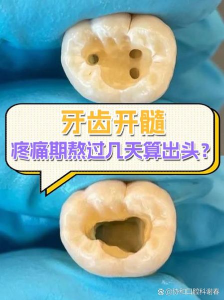 孕妇牙髓炎怎么快速止痛_孕妇牙髓炎止痛方法-第2张图片-星辰妙记