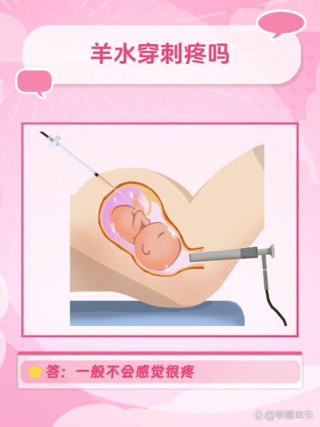 孕妇做羊水穿刺对胎儿有影响吗_羊水穿刺风险大不大-第1张图片-星辰妙记