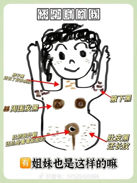 孕妇肚脐眼黑是什么原因_孕妇肚脐发黑怎么改善-第3张图片-星辰妙记