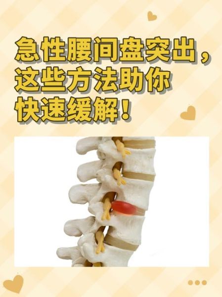 孕妇腰间盘突出能顺产吗_孕期腰突如何缓解疼痛-第3张图片-星辰妙记