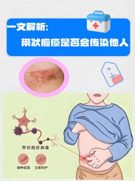 孕妇带状疱疹图片_对胎儿有影响吗-第2张图片-星辰妙记