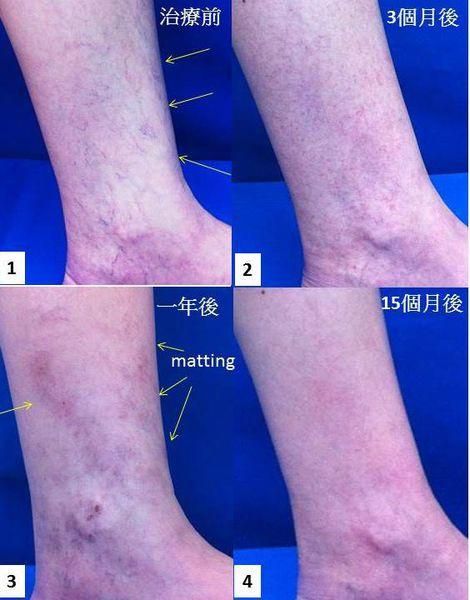 孕妇大腿有紫色血丝怎么办_怀孕静脉曲张怎么缓解-第2张图片-星辰妙记 孕妇大腿有紫色血丝怎么办_怀孕静脉曲张怎么缓解-第2张图片-星辰妙记