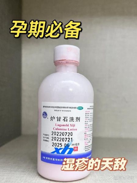 孕妇有湿疹用什么药_孕妇湿疹能涂什么药膏-第1张图片-星辰妙记