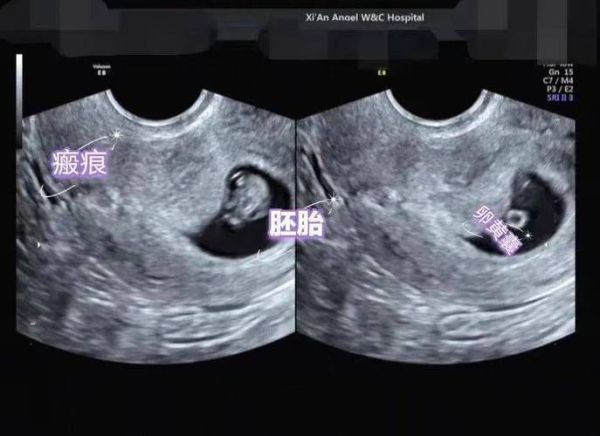 孕妇做b超需要空腹吗_孕早期b超注意事项-第1张图片-星辰妙记