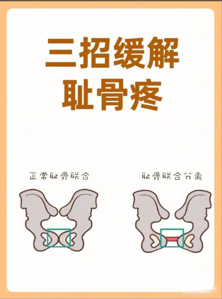 孕妇耻骨痛怎么缓解_耻骨联合痛缓解方法-第1张图片-星辰妙记 孕妇耻骨痛怎么缓解_耻骨联合痛缓解方法-第1张图片-星辰妙记