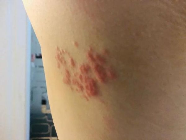 孕妇带状疱疹能自愈吗_对胎儿影响大吗-第3张图片-星辰妙记 孕妇带状疱疹能自愈吗_对胎儿影响大吗-第3张图片-星辰妙记