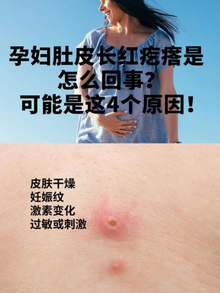 孕妇身上起红疙瘩很痒怎么办_孕期皮肤瘙痒怎么缓解-第1张图片-星辰妙记