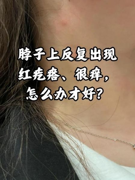 孕妇身上起红疙瘩很痒怎么办_孕期皮肤瘙痒怎么缓解-第3张图片-星辰妙记
