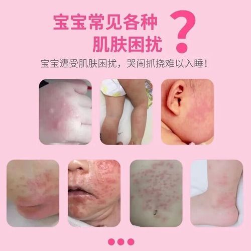 孕妇能用炉甘石洗剂吗_孕期皮肤痒怎么办-第3张图片-星辰妙记
