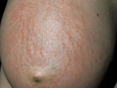 孕妇肚子上起了好多小红点_对胎儿有影响吗-第1张图片-星辰妙记