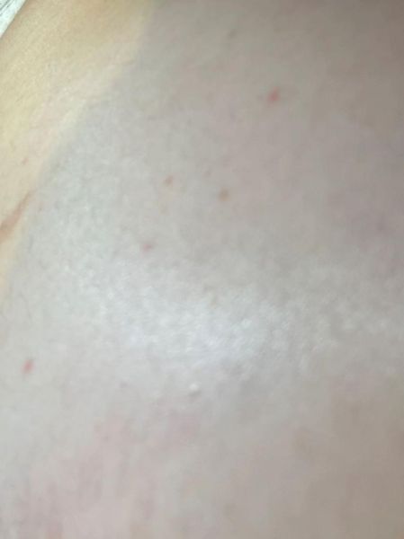 孕妇肚子上起了好多小红点_对胎儿有影响吗-第3张图片-星辰妙记