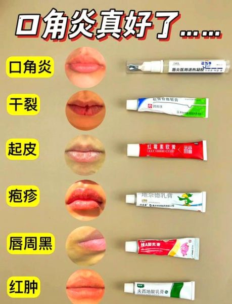 孕妇嘴角长疱疹怎么办_会影响胎儿吗-第3张图片-星辰妙记