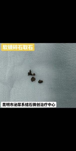 孕妇结石怎么办_孕妇结石对胎儿有影响吗-第2张图片-星辰妙记