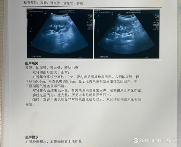 孕妇结石怎么办_孕妇结石对胎儿有影响吗-第3张图片-星辰妙记